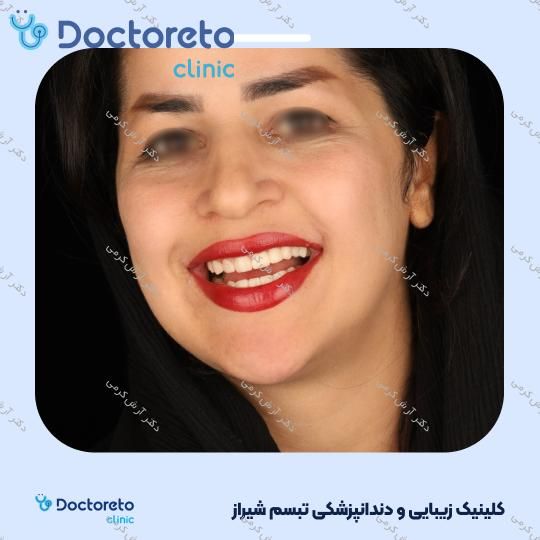 ایمپلنت دیجیتال dio کره ای با روکش (هر واحد) دکتر آرش کرمی در شیراز 81