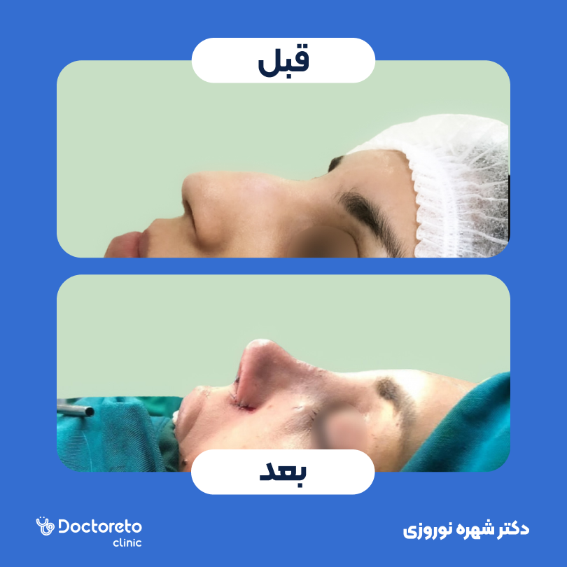 عمل زیبایی بینی (رینوپلاستی) دکتر شهره نوروزی در اهواز 3