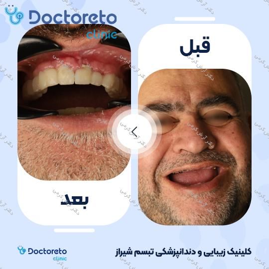 ایمپلنت دیجیتال dio کره ای با روکش (هر واحد) دکتر آرش کرمی در شیراز 132