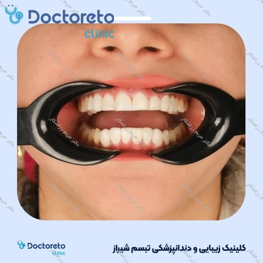 ونیر کامپوزیت سارمکو سوئیسی (هر واحد) دکتر مریم زراعتکار در شیراز 18