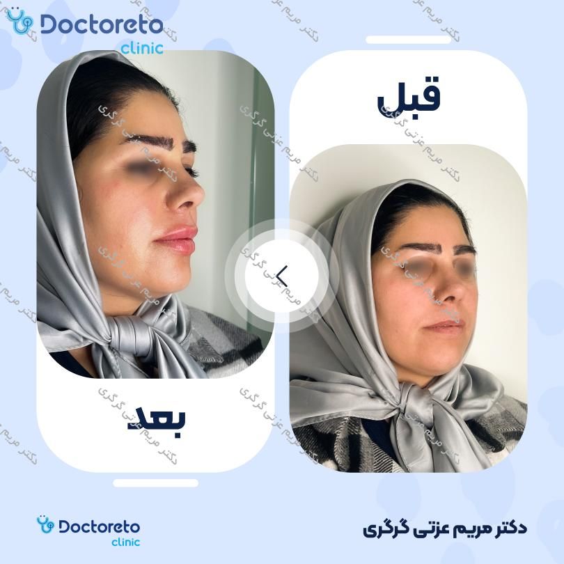 تزریق ژل لب با برند اینووسنس (1CC) دکتر مریم عزتی گرگری در تهران 4