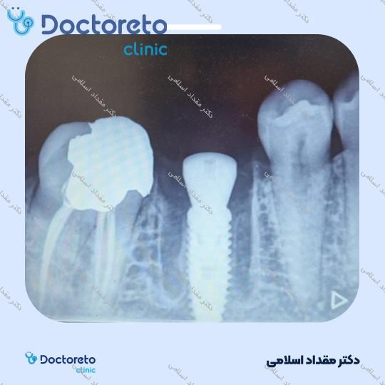 ایمپلنت اشترومن سوئیسی تیتانیوم با روکش ( هرواحد ) دکتر مقداد اسلامی در تهران 2