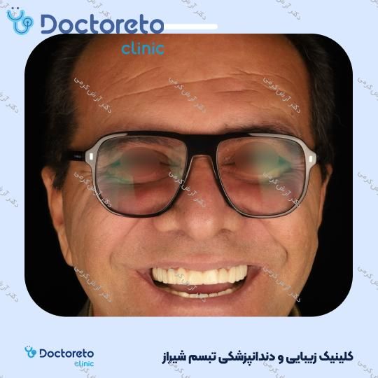 ایمپلنت دیجیتال dio کره ای با روکش (هر واحد) دکتر آرش کرمی در شیراز 70