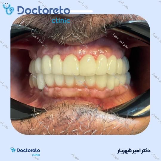 ایمپلنت نئودنت برزیلی با روکش (هر واحد) دکتر امیر شهریار در تهران 6