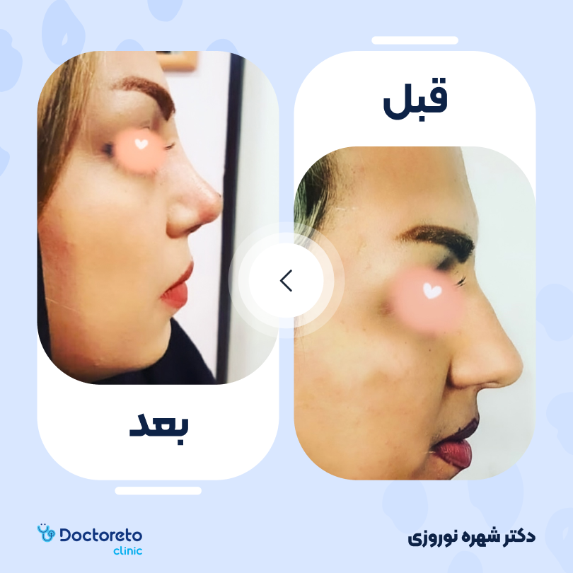 عمل زیبایی بینی (رینوپلاستی) دکتر شهره نوروزی در اهواز 6