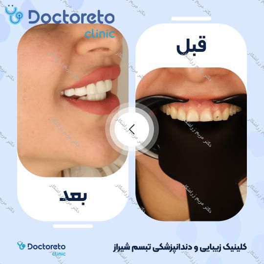 ونیر کامپوزیت توکویاما ژاپنی (هر واحد) دکتر مریم زراعتکار در شیراز 8