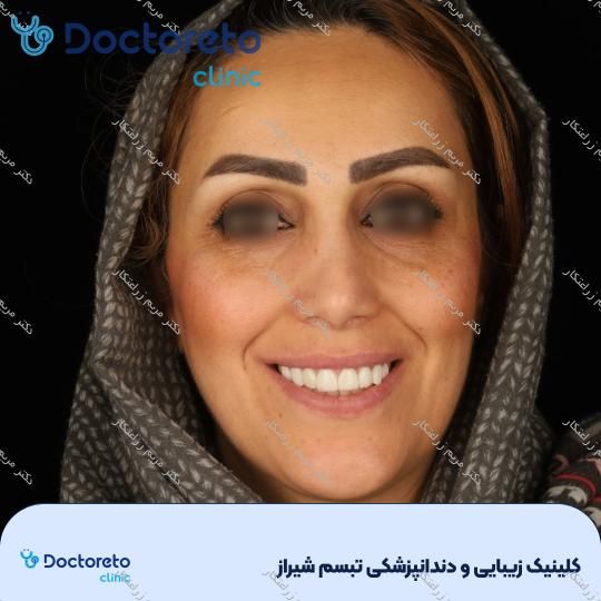 ونیر کامپوزیت توکویاما ژاپنی (هر واحد) دکتر مریم زراعتکار در شیراز 25
