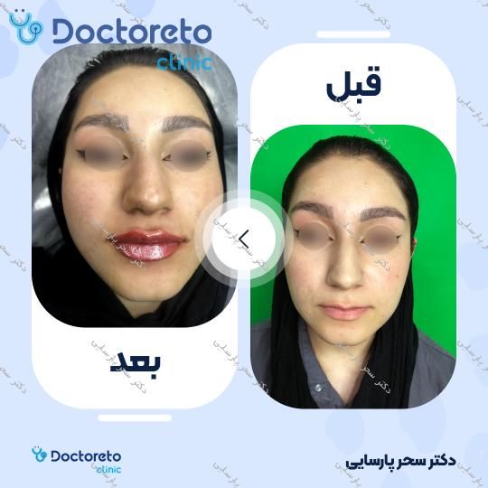 تزریق ژل لب با برند روولاکس (1CC) دکتر سحر پارسایی در مشهد 8