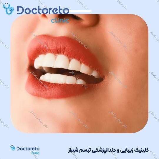 ونیر کامپوزیت توکویاما ژاپنی (هر واحد) دکتر مریم زراعتکار در شیراز 6