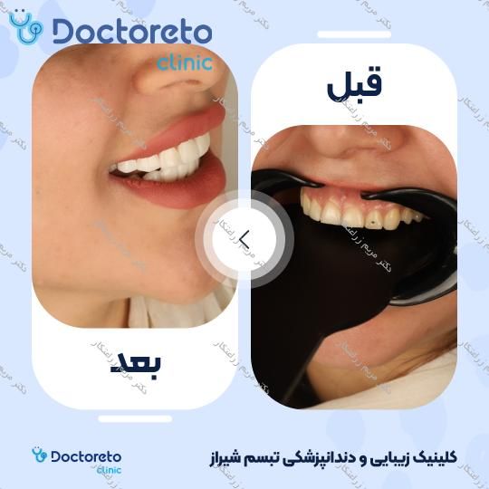 ونیر کامپوزیت توکویاما ژاپنی (هر واحد) دکتر مریم زراعتکار در شیراز 7