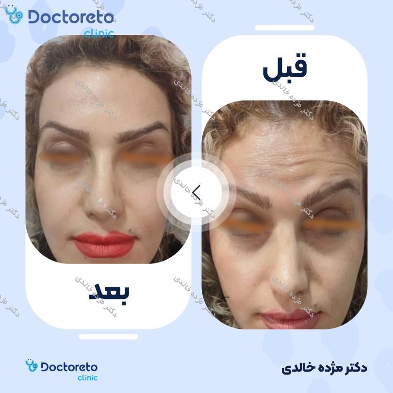 تزریق بوتاکس خط اخم با برند مصپورت