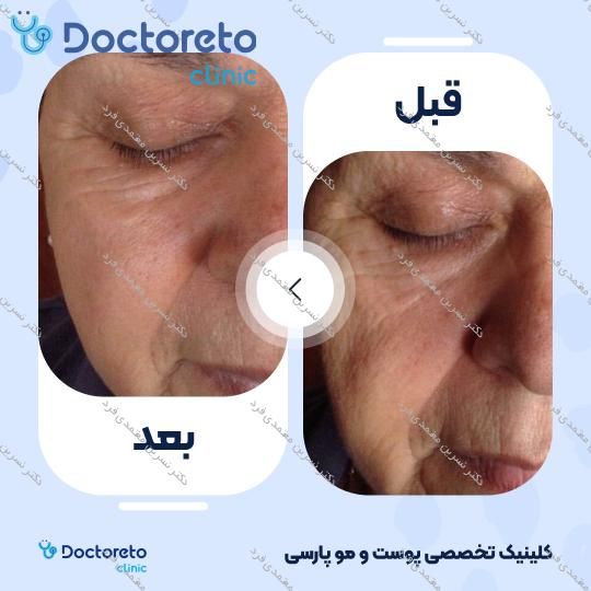 هایفوتراپی صورت و غبغب با دستگاه 7 بعدی اولترا (هر جلسه) دکتر نسرین معتمدی فرد در اصفهان 3