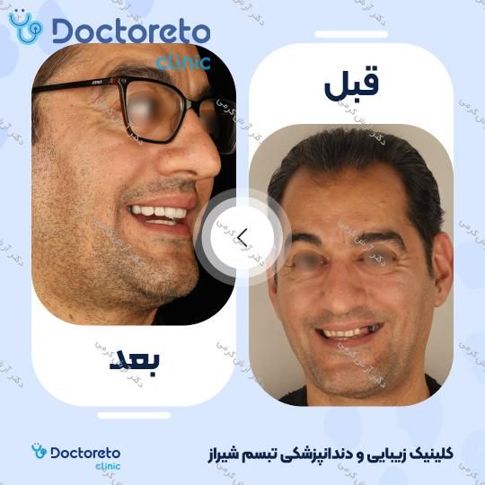 ایمپلنت دیجیتال dio کره ای با روکش (هر واحد) دکتر آرش کرمی در شیراز 108