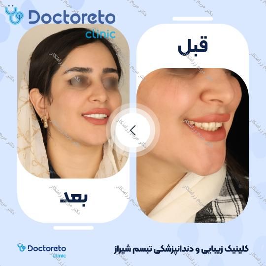 ونیر کامپوزیت توکویاما ژاپنی (هر واحد) دکتر مریم زراعتکار در شیراز 17