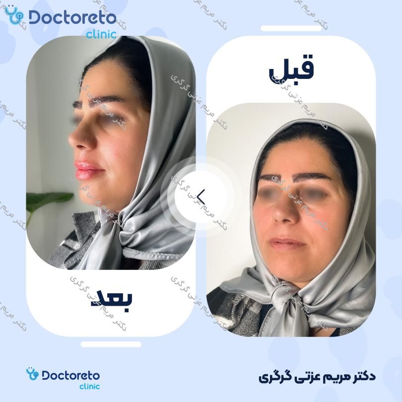 تزریق ژل لب با برند اینووسنس (1CC) دکتر مریم عزتی گرگری در تهران 5