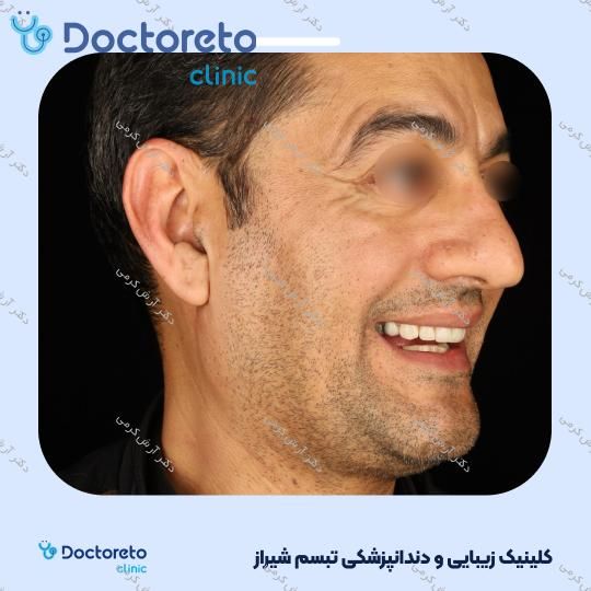 ایمپلنت دیجیتال dio کره ای با روکش (هر واحد) دکتر آرش کرمی در شیراز 98