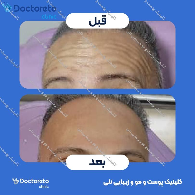 تزریق بوتاکس صورت (پیشانی، خط اخم، پنجه کلاغی) با برند دیستون کلینیک پوست و مو و زیبایی نلی در شیراز 2