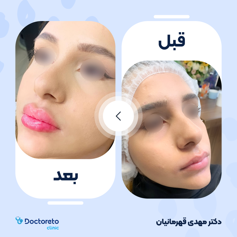 تزریق ژل لب با برند رووفیل (1cc)