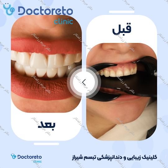 ونیر کامپوزیت توکویاما ژاپنی (هر واحد) دکتر مریم زراعتکار در شیراز 14