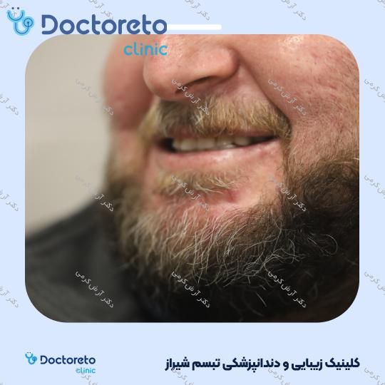 ایمپلنت دیجیتال دنتیس کره ای با روکش (هر واحد) دکتر آرش کرمی در شیراز 54