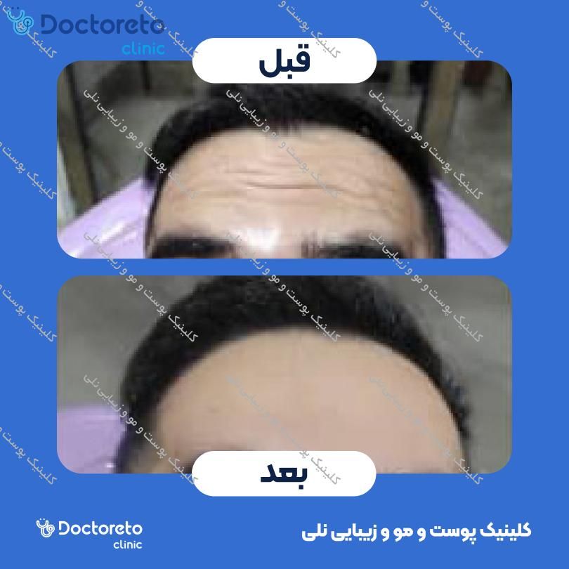 تزریق بوتاکس صورت (پیشانی، خط اخم، پنجه کلاغی) با برند دیستون