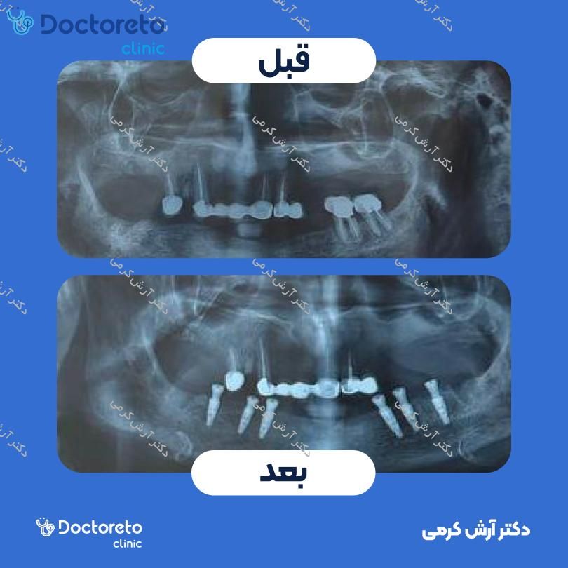 ایمپلنت اشترومن iti سوئیسی بدون روکش (هر واحد)