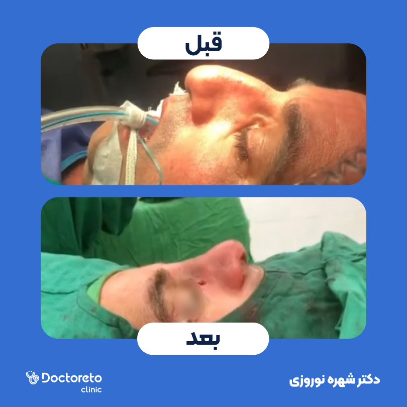 عمل جراحی مجدد زیبایی بینی (رینوپلاستی)