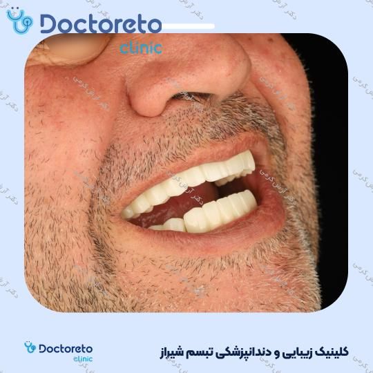 ایمپلنت دیجیتال dio کره ای با روکش (هر واحد) دکتر آرش کرمی در شیراز 117