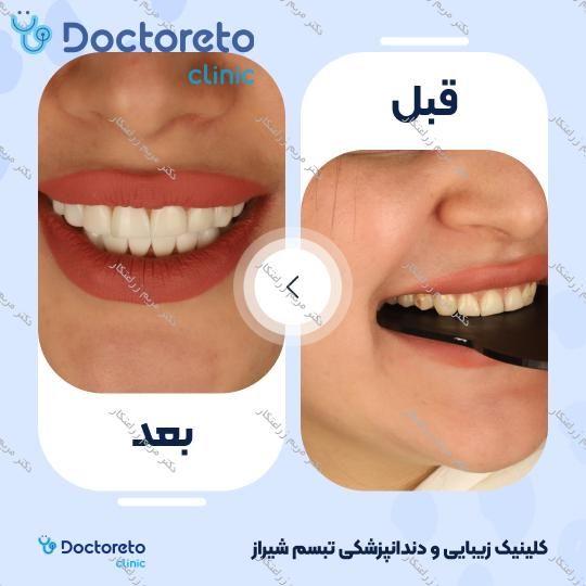 ونیر کامپوزیت توکویاما ژاپنی (هر واحد) دکتر مریم زراعتکار در شیراز 10