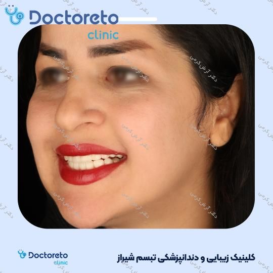 ایمپلنت دیجیتال dio کره ای با روکش (هر واحد) دکتر آرش کرمی در شیراز 82