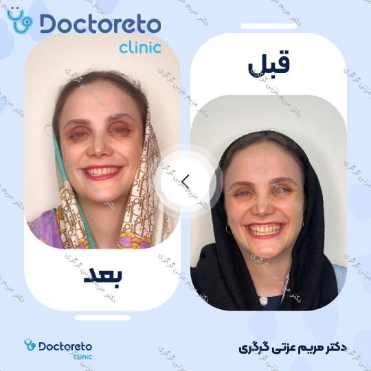 تزریق بوتاکس صورت (پیشانی، دور چشم و پل بینی) با برند مصپورت دکتر مریم عزتی گرگری در تهران 3