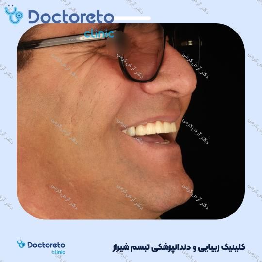 ایمپلنت دیجیتال دنتیس کره ای بدون روکش (هر واحد) دکتر آرش کرمی در شیراز 62