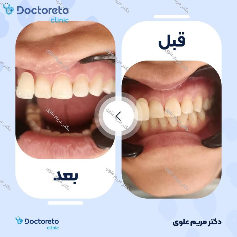 آفیس بلیچینگ (سفید کردن دندان) دو فک با مواد وایت اسمایل آلمان