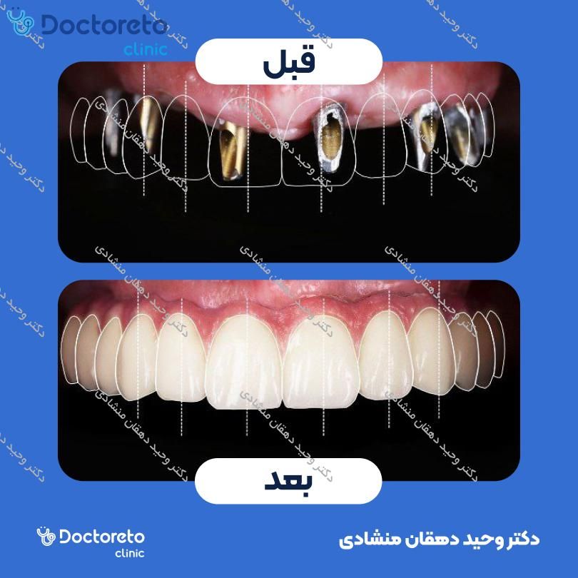 ایمپلنت چاروم کره ای بدون روکش (هر واحد)