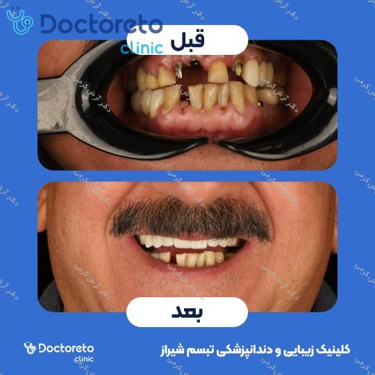 ایمپلنت دیجیتال dio کره ای با روکش (هر واحد) دکتر آرش کرمی در شیراز 46