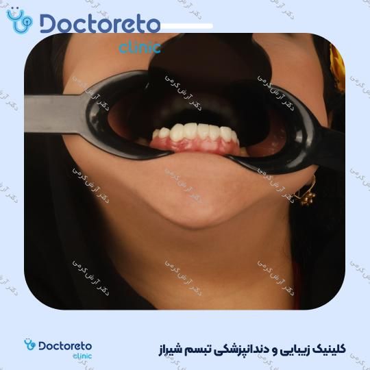 ایمپلنت دیجیتال dio کره ای با روکش (هر واحد) دکتر آرش کرمی در شیراز 90