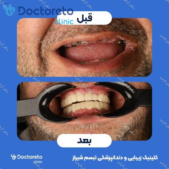 ایمپلنت دیجیتال دنتیس کره ای بدون روکش (هر واحد) دکتر آرش کرمی در شیراز 129