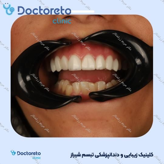 ونیر کامپوزیت توکویاما ژاپنی (هر واحد) دکتر مریم زراعتکار در شیراز 20