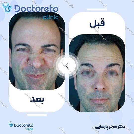 تزریق بوتاکس صورت (پیشانی، خط اخم، دور چشم) با برند دیستون