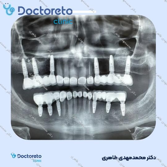 ایمپلنت آلفادنت آلمانی با روکش (هر واحد)