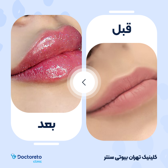 تزریق ژل لب با برند رووفیل (1cc)