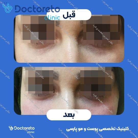 تزریق ژل زیرچشم با برند نورامیس (1CC)