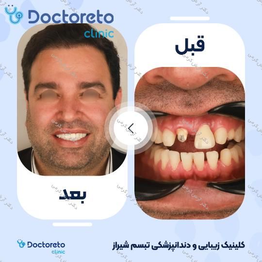 ایمپلنت دیجیتال dio کره ای با روکش (هر واحد) دکتر آرش کرمی در شیراز 28