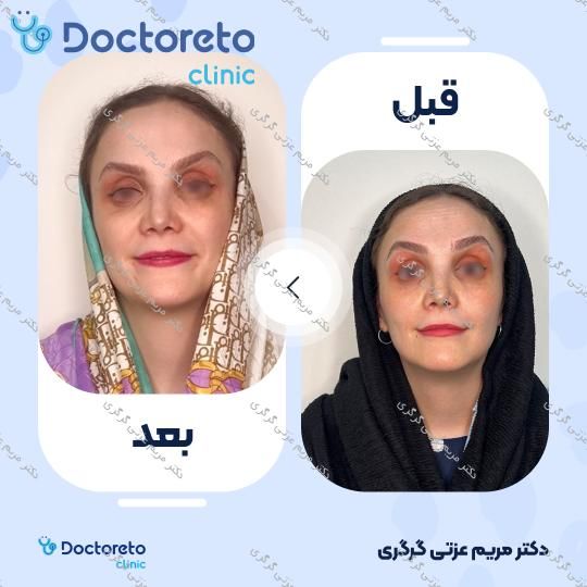 تزریق بوتاکس صورت (پیشانی، دور چشم و پل بینی) با برند مصپورت