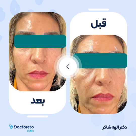 تزریق ژل خط خنده با برند درمال استایل (1CC)