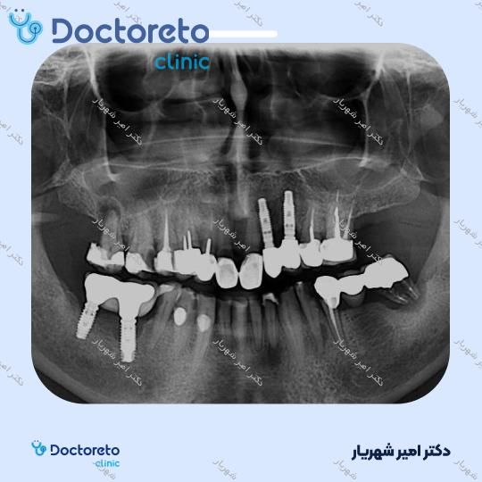 ایمپلنت نئودنت برزیلی با روکش (هر واحد) دکتر امیر شهریار در تهران 7