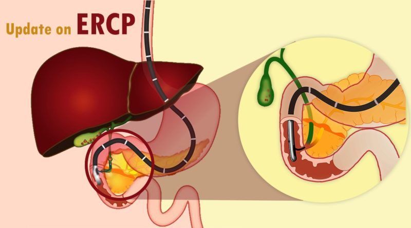 درمان و تصویر برداری مشکلات مجاری صفراوی به روش ERCP