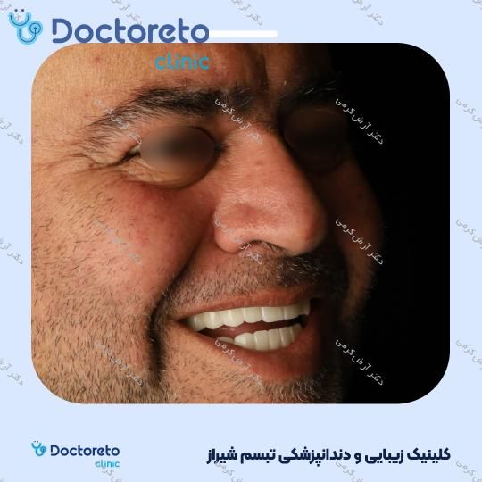 ایمپلنت دیجیتال دنتیس کره ای با روکش (هر واحد) دکتر آرش کرمی در شیراز 131