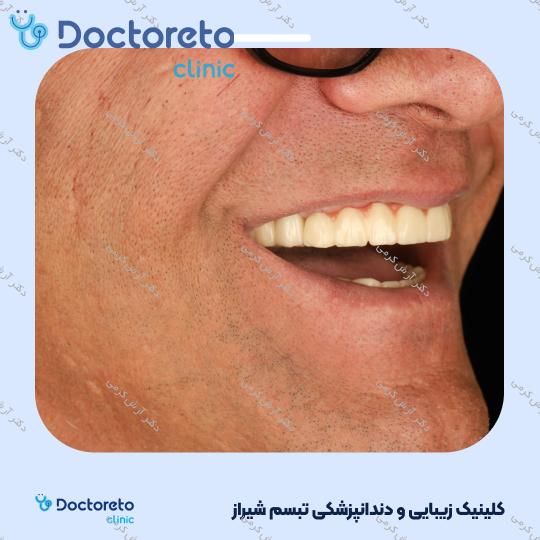 ایمپلنت دیجیتال dio کره ای با روکش (هر واحد) دکتر آرش کرمی در شیراز 69