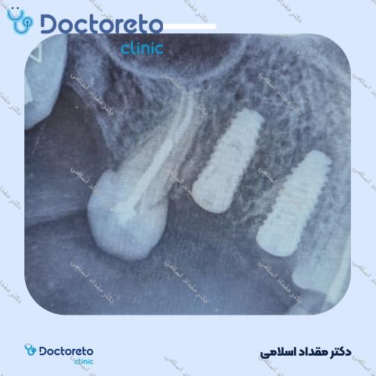 ایمپلنت نئودنت سوئیسی با روکش ( هرواحد ) دکتر مقداد اسلامی در تهران 2